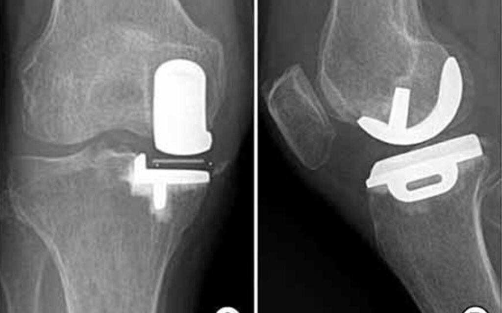 Robotic Partial Knee Replacement in Mumbai